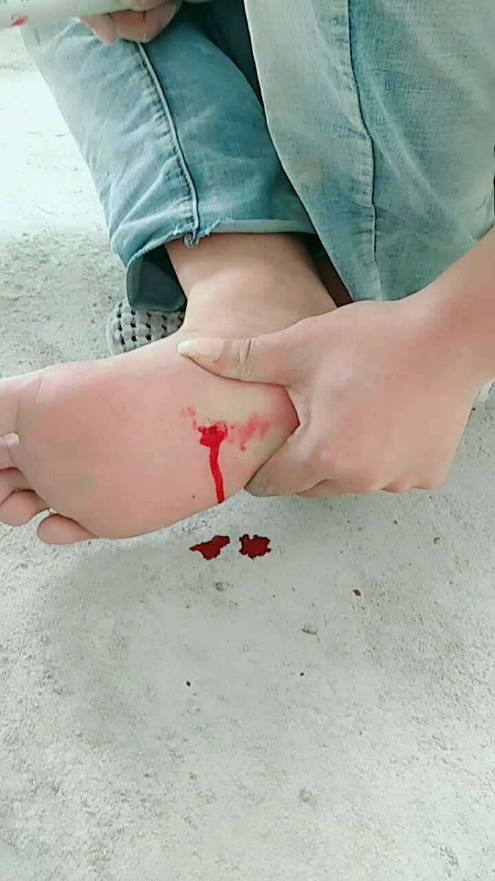 脚踩到钉子受伤的图片图片