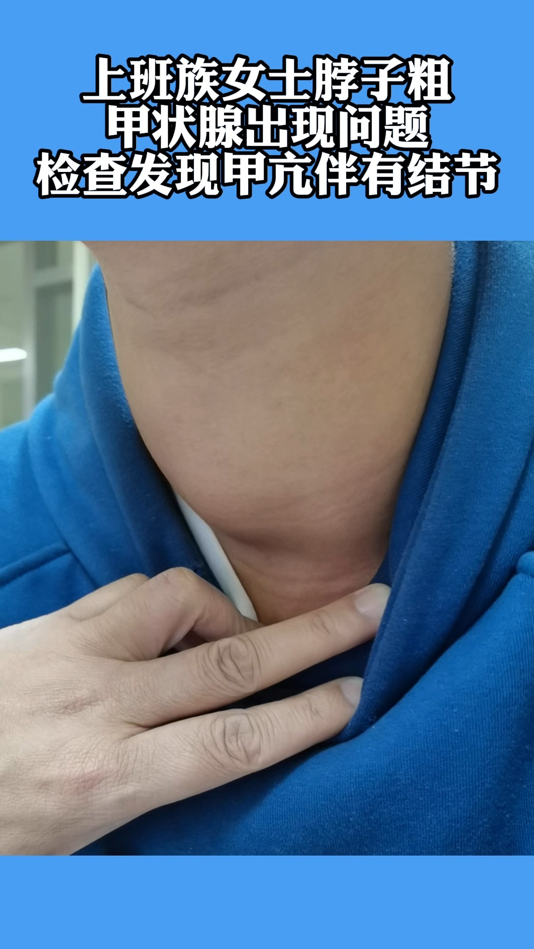 33岁上班族女士,照镜子发现脖子粗了一截,哪知道甲状腺出了问题,检查