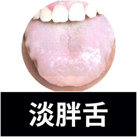 舌相分析:淡胖舌93有齿痕 治法:温阳,滋肾,固涩