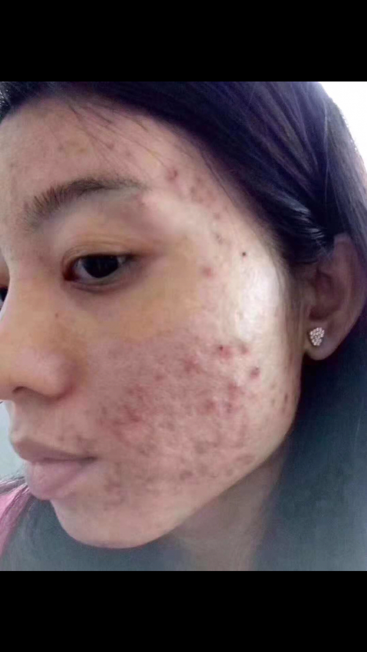 从满脸痘痘到嫩白肌肤,我只用了一个多月的时间,想知道方法的私信我吧