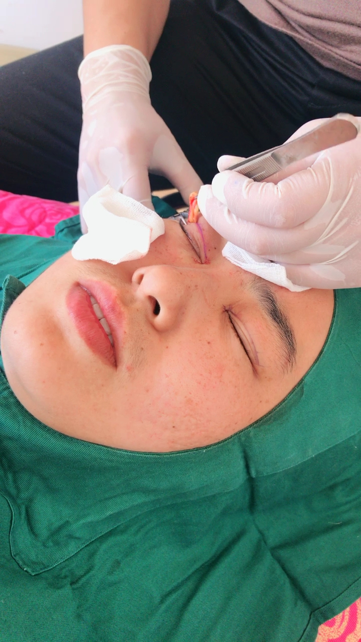 开眼角77抽脂纳米无痕双眼皮术中