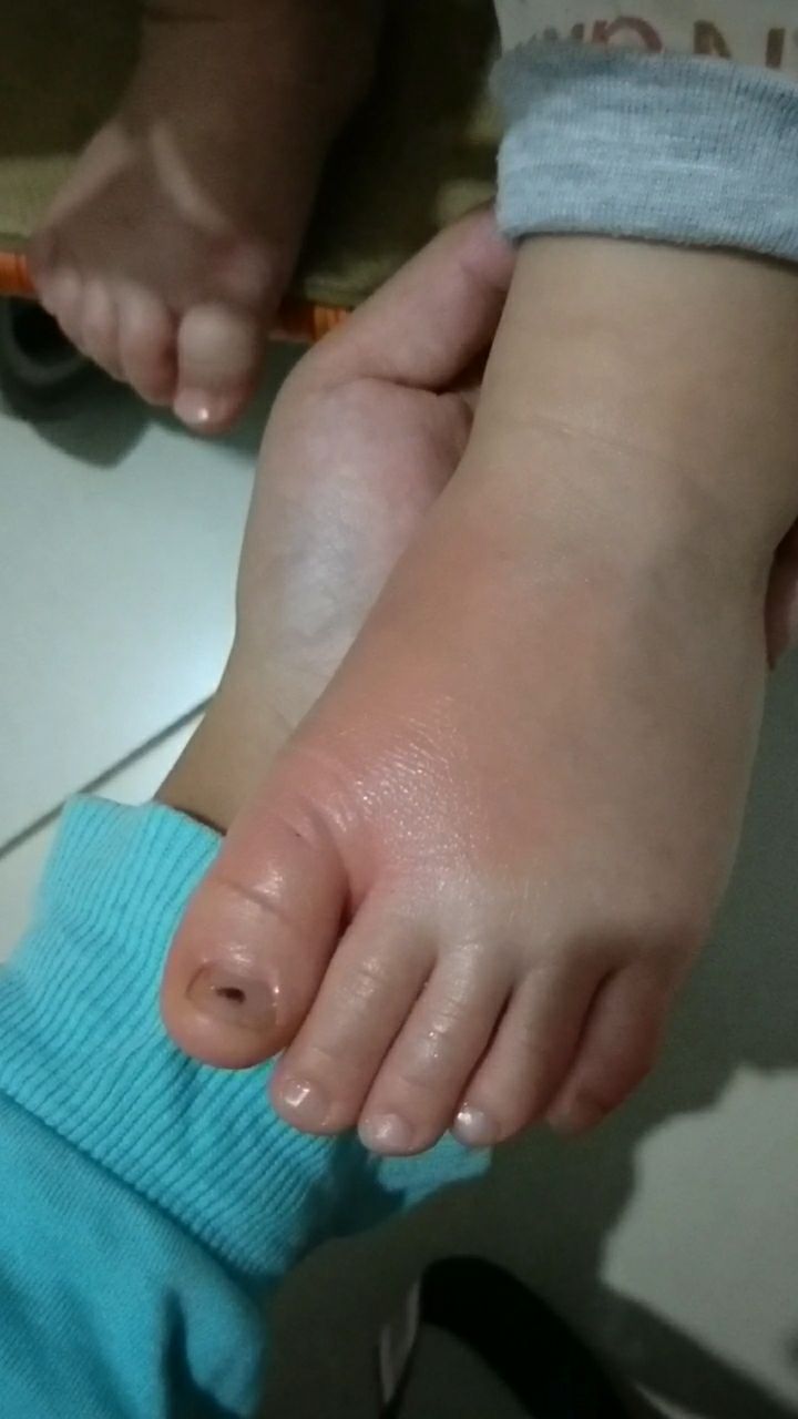 洗澡的时候把宝贝的脚烫到了!好心疼!