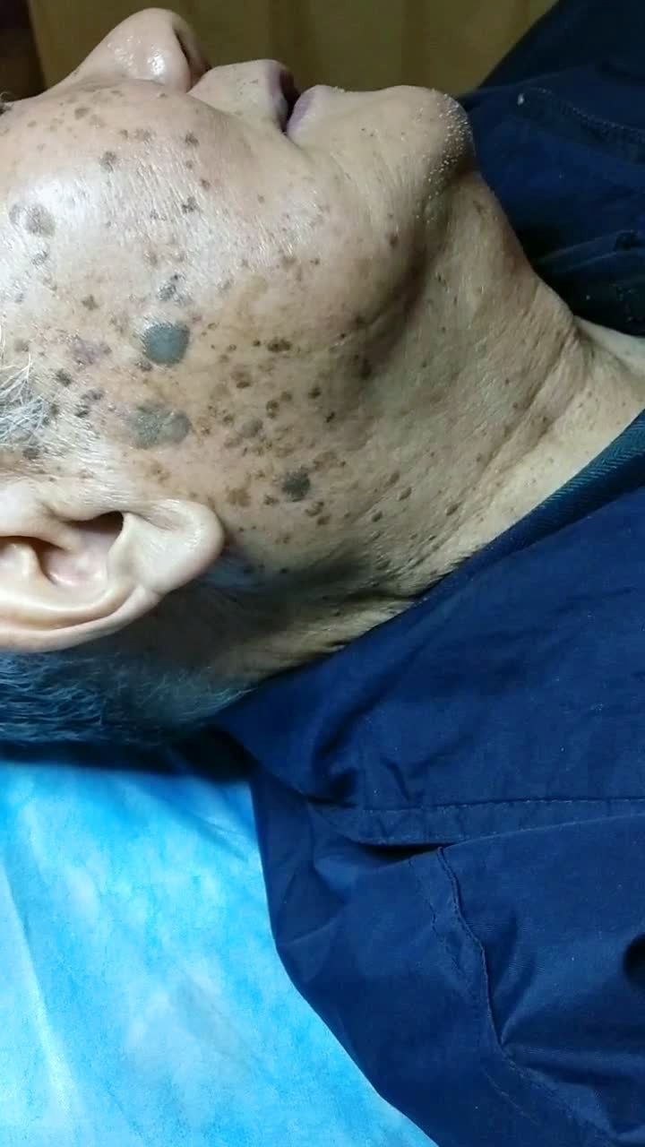 老大爷的超级老年疣祛除后修复的很不错,又过来补一补漏下的.