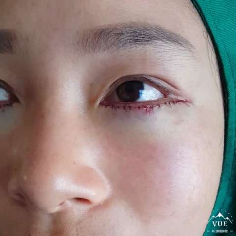 祛眼袋手术完成,美美的告别大眼袋,恢复好更好看04