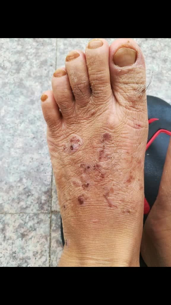 这是泡了一星期的效果,被脚癣91咬过的都呈现出脚面上了,黑皮是干了