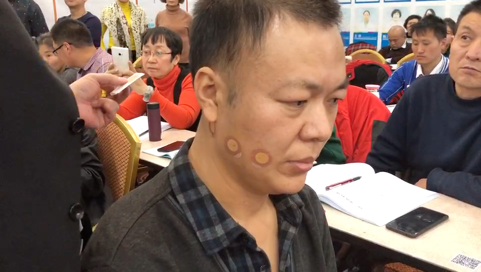 埋线地仓,耳前穴,治疗面瘫,面肌痉挛