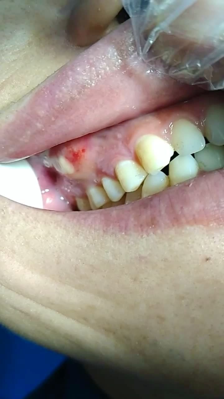 后槽牙那里长出来一颗多生牙