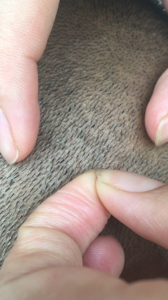 哥哥头皮毛囊里长出很多粗黑长的东西,要紧吗,在线等