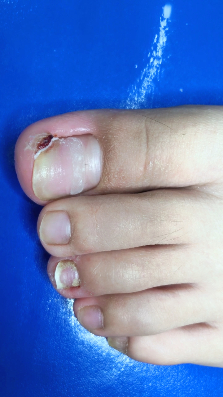 甲沟炎嵌甲矫正,指甲甲床矫正后变宽,让指甲不在见缝插针!
