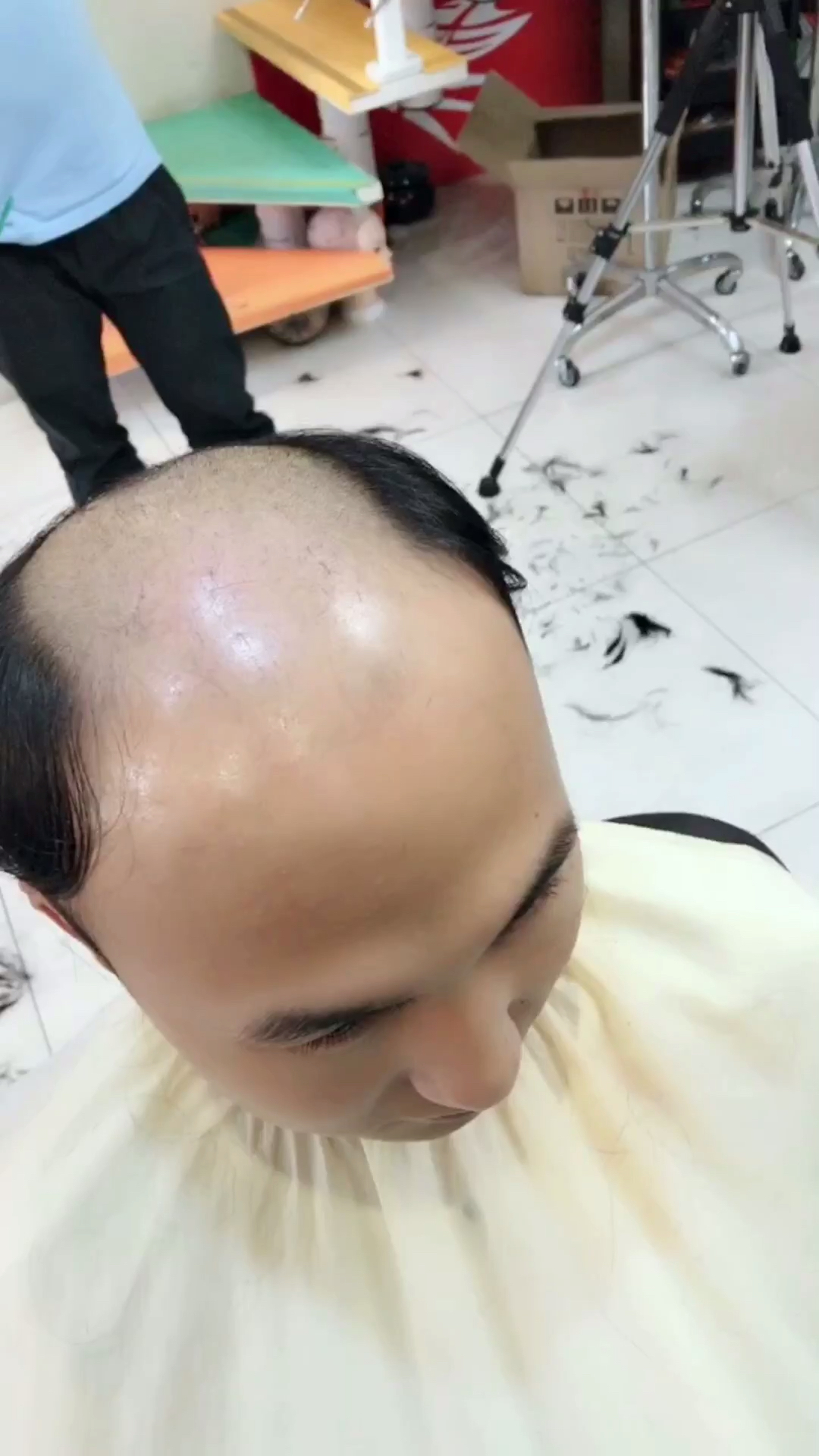 脱发秃顶地中海,年纪轻轻显老态,量身定制补发块,马上变身高富帅!