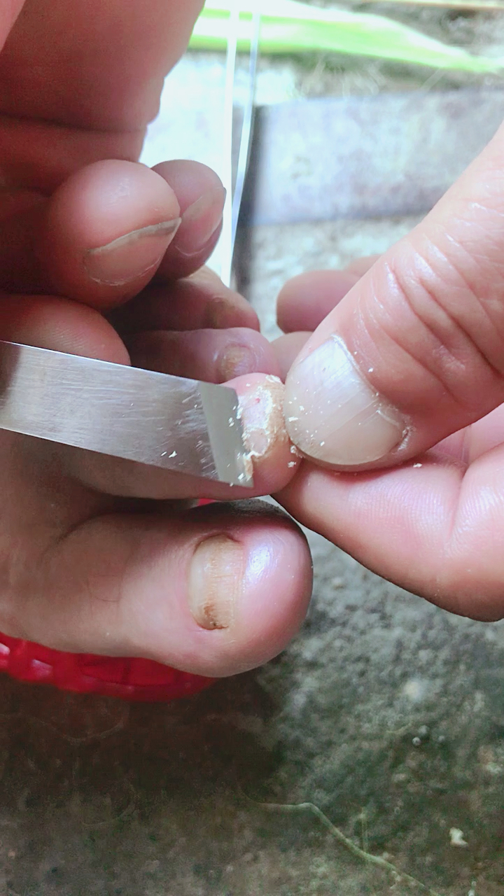 去除跖疣,上药拔根