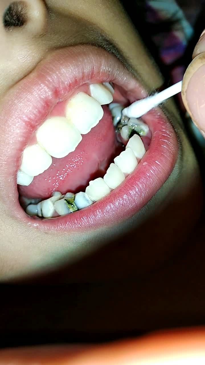 2018年8月2日晚上21:30分钟拍摄我的侄女的牙齿被虫子掉了.