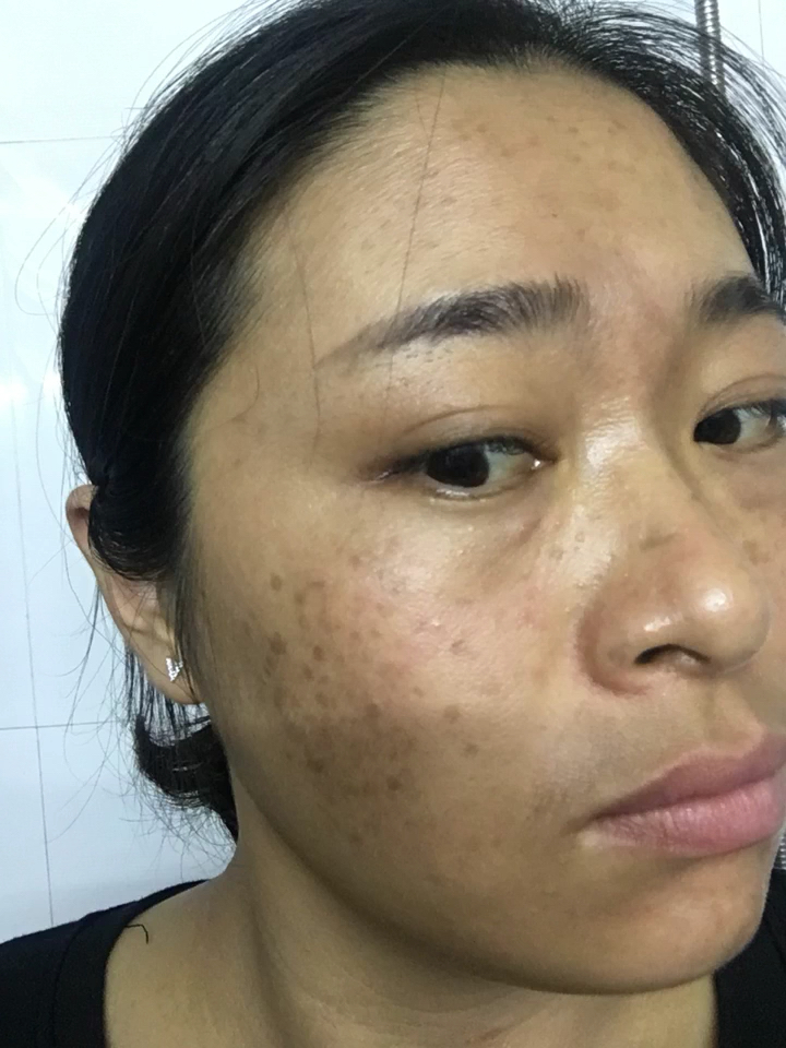 生完两个宝宝 皮肤更暗黄了 斑也更多了 老公都不愿意看我