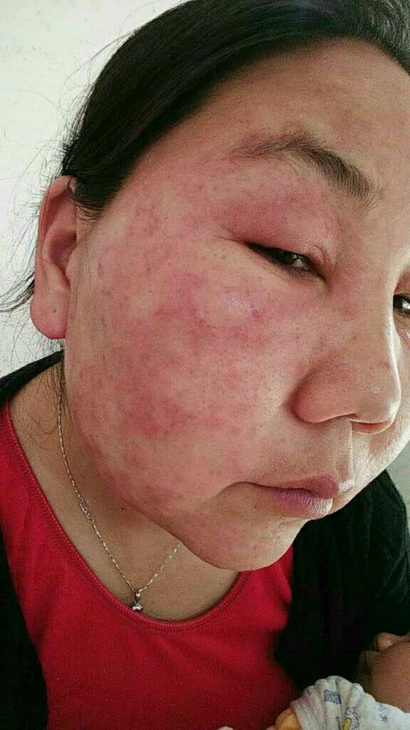 荨麻疹长脸上状况图图片