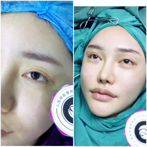 膨体隆眉弓术后即刻